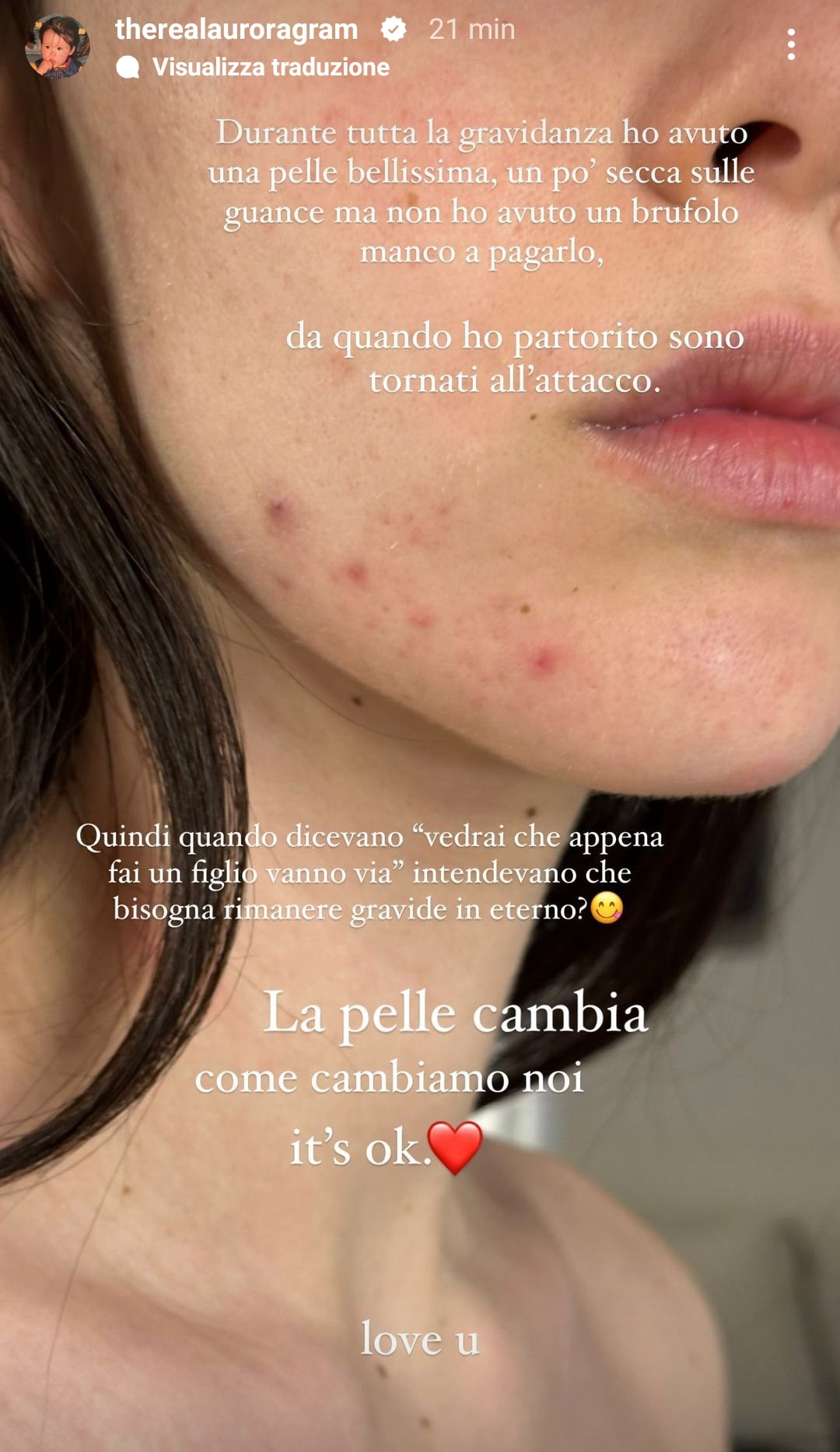 Aurora Ramazzotti e il ritorno dell'acne. Fonte: therealauroragram - Instagram