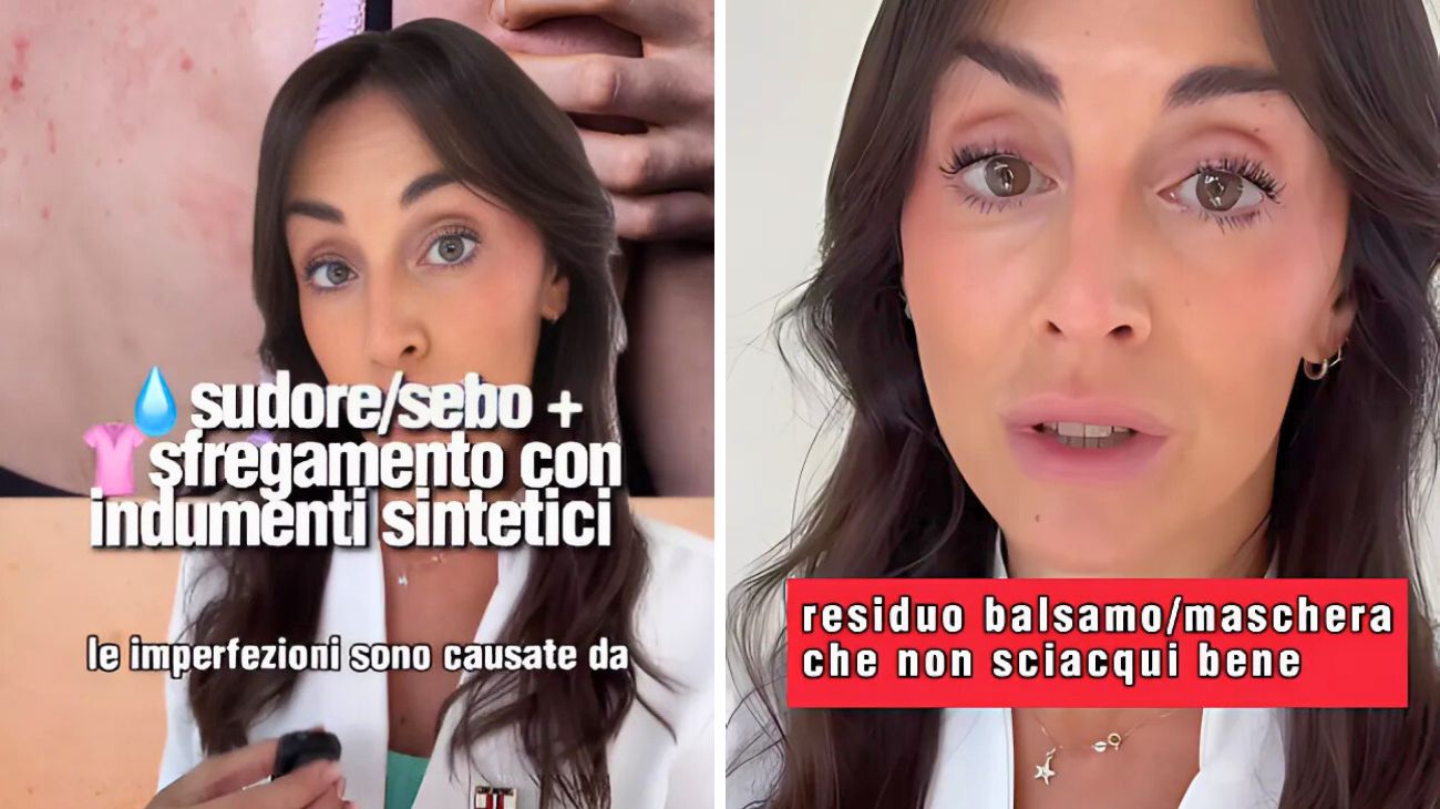 Acne sulla schiena