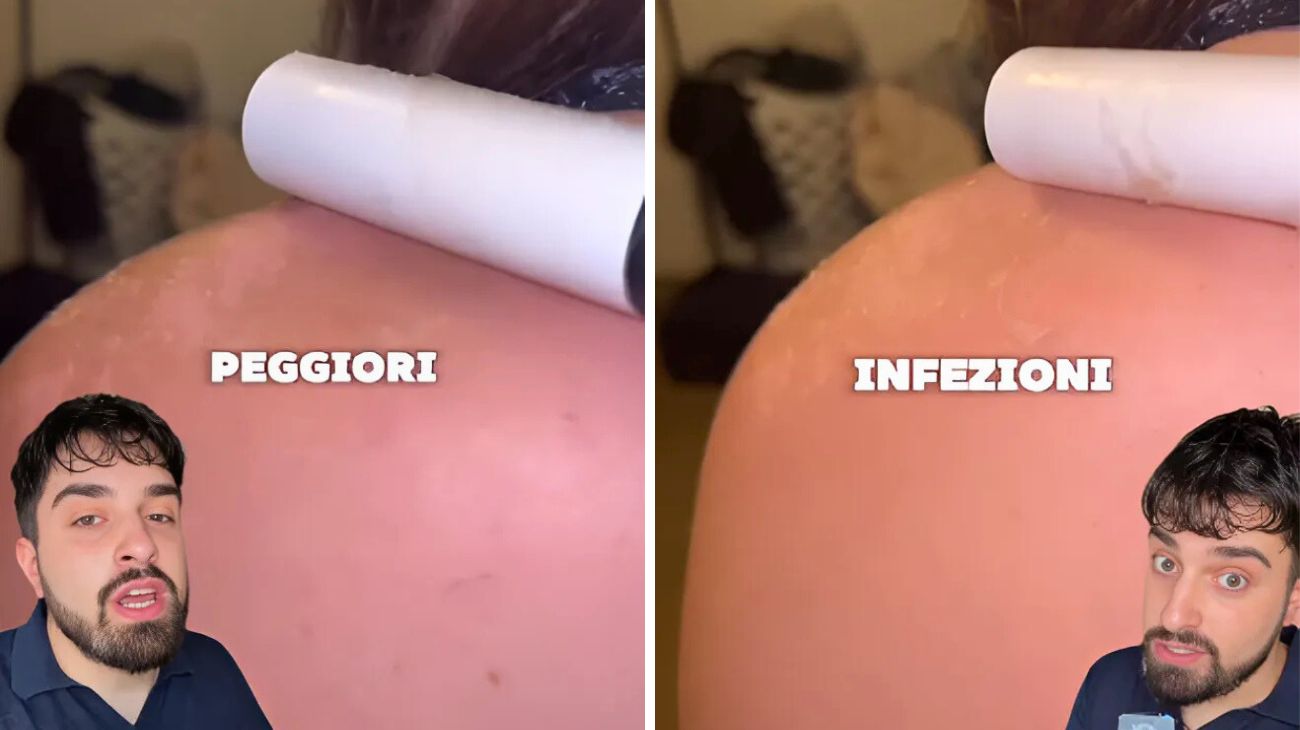 Ustioni solari